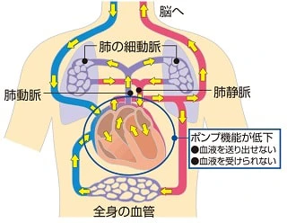 心原性ショックの仕組み説明図