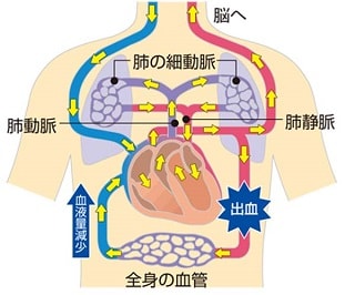 出血性ショックの仕組み
