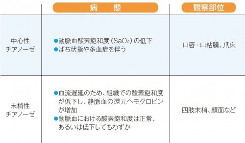 チアノーゼの病態と観察部位