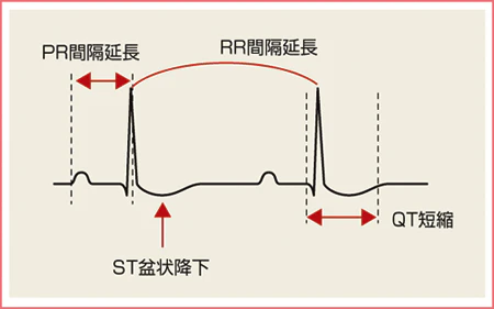 ジギタリス効果の波形