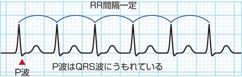 房室結節リエントリー性頻拍(AVNRT)の波形