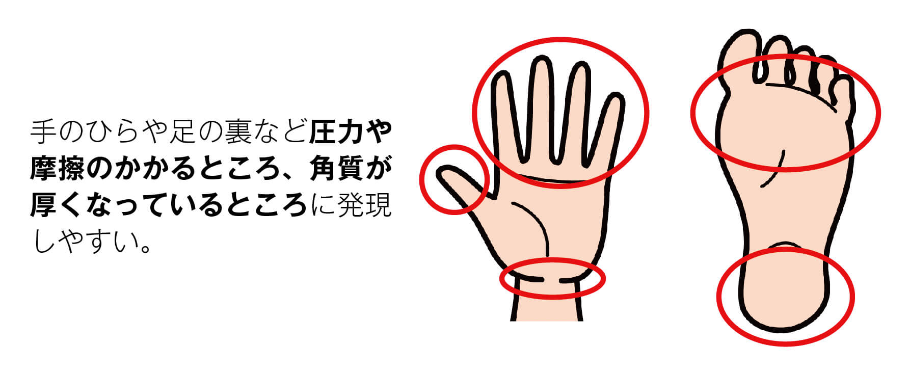 手足症候群が発現しやすい部位