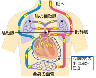 心タンポナーデの仕組み説明図
