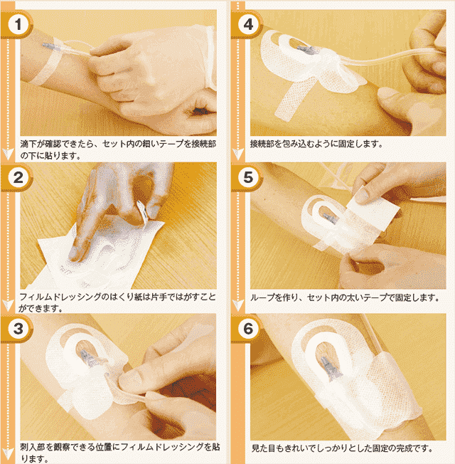 末梢静脈カテーテルの固定手順