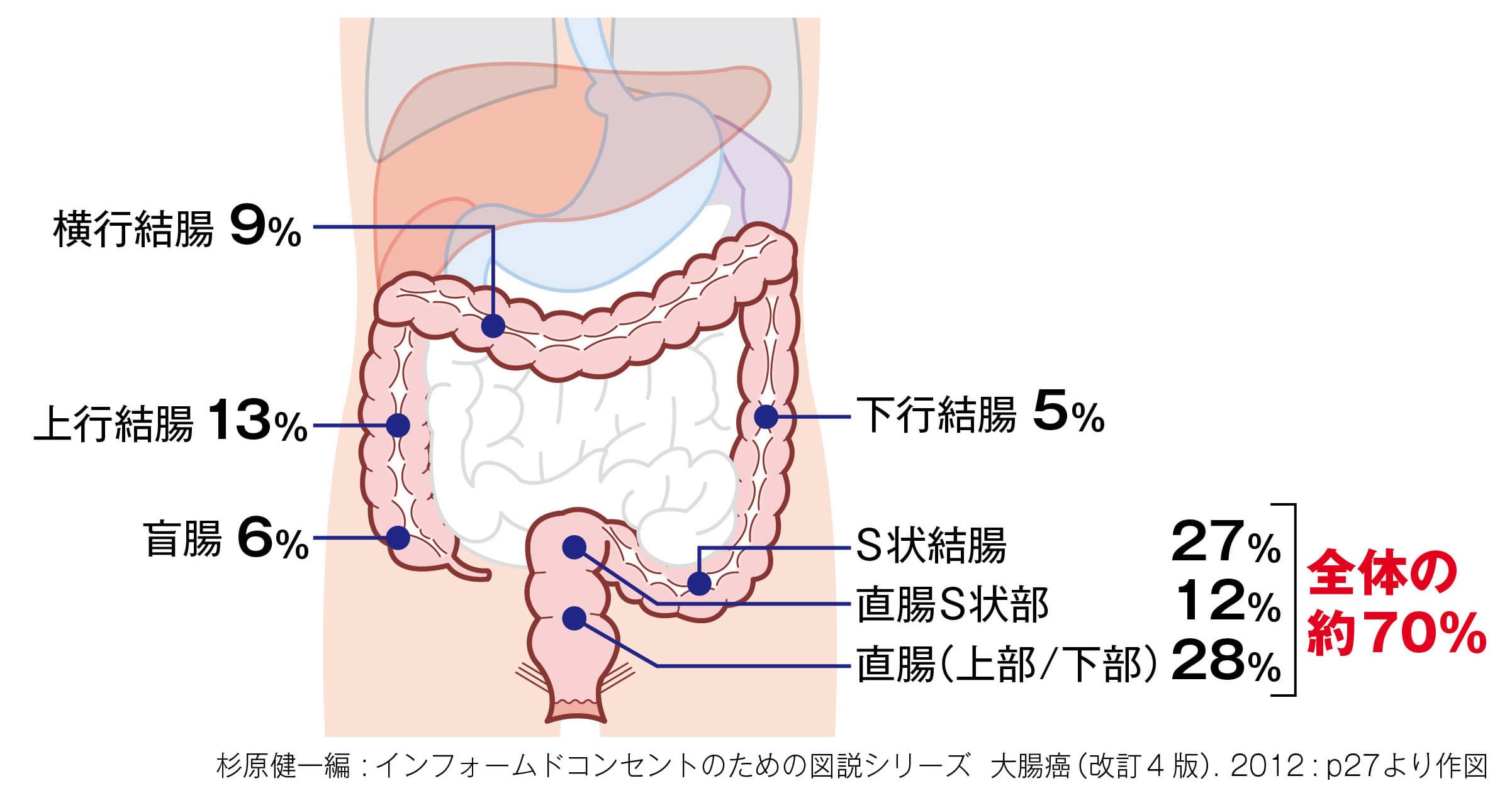 大腸がんの好発部位