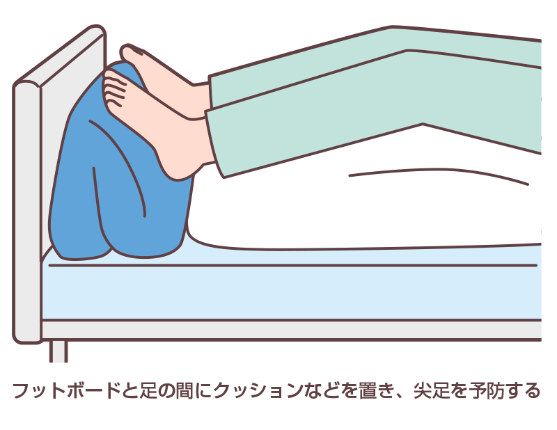 図2 尖足予防の例