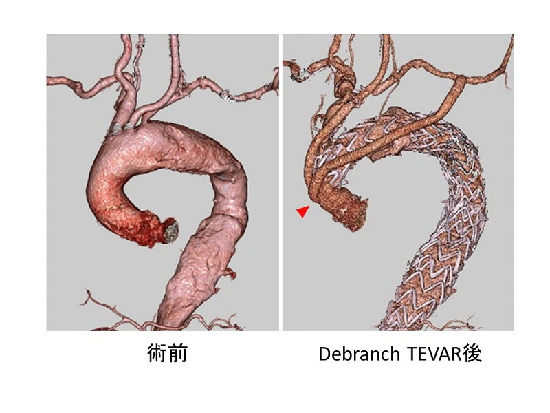 TEVARおよび主要動脈へのバイパス手術