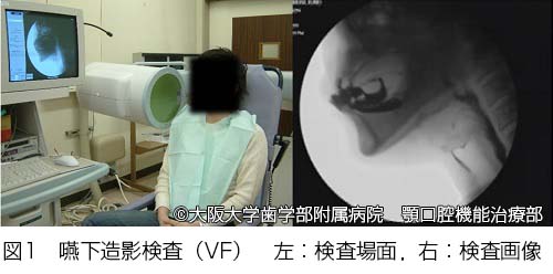 実際の嚥下造影検査の様子、写真