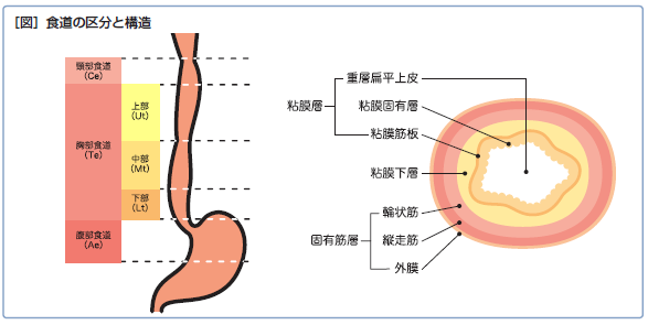 食道がん説明図