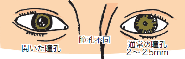 瞳孔の変化説明図
