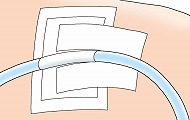 ドレーンの固定法説明図②