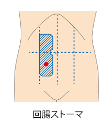 回腸ストーマ