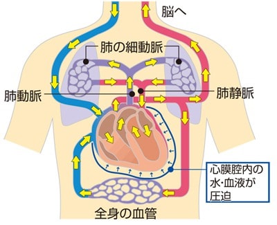 心タンポナーデの仕組み