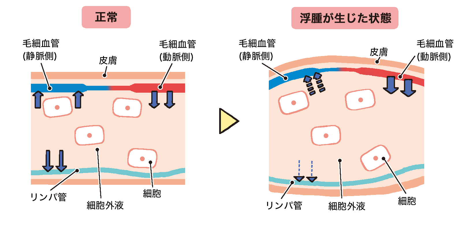 浮腫の補足資料