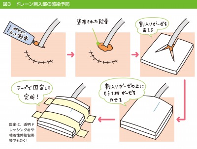 ドレーン刺入部の感染予防