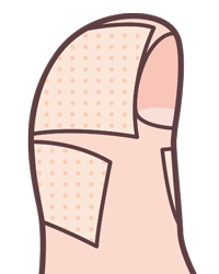 爪囲炎のテーピング見本
