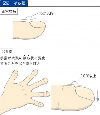 ばち指