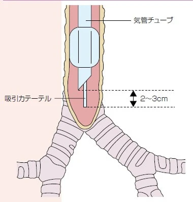 カテーテルの挿入範囲説明図