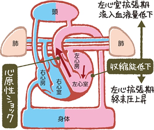 左心不全説明図