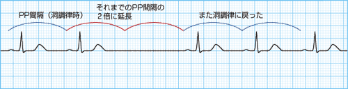 洞房ブロックの波形