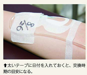 カテーテル固定写真