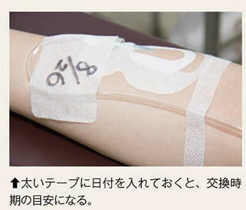 カテーテル固定写真