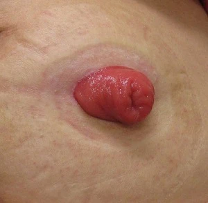S状結腸単孔式ストーマ実際の写真