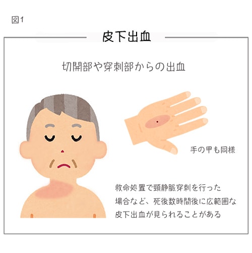 皮下出血