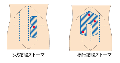 S状結腸ストーマと横行結腸ストーマ