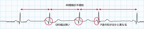 心房性期外収縮(PAC)の心電図波形