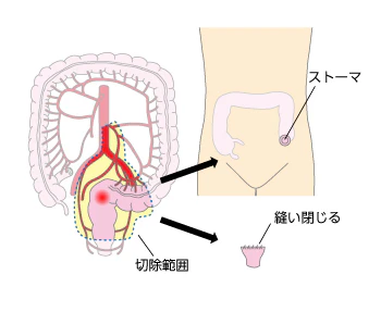 ハルトマン手術