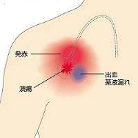 潰瘍の形成