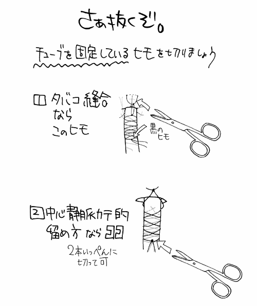 >>胸腔ドレーンの抜去手順 糸を切る
