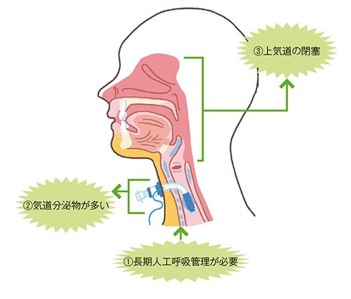 気管切開の適応