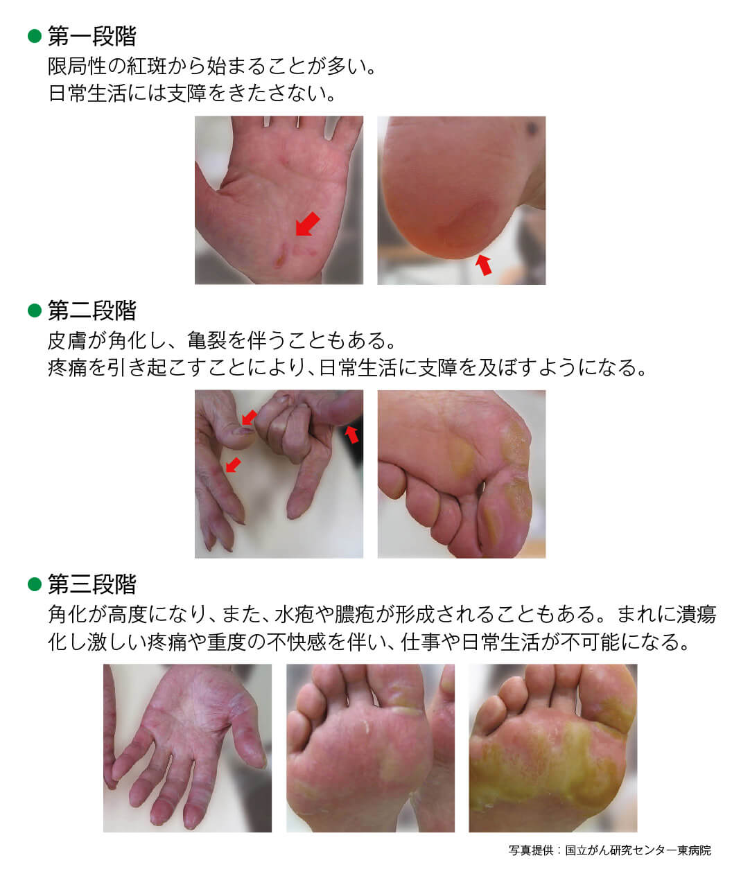 スチバーガ®による手足症候群の症状説明写真
