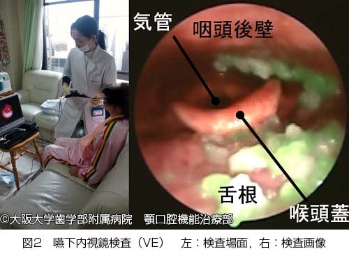 実際の嚥下内視鏡検査の様子、写真