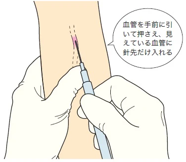 蛇行した血管への穿刺