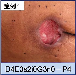 褥瘡治療 症例