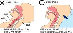 ベッドでの食事時の頭位