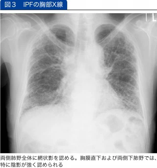 IPFの胸部X線