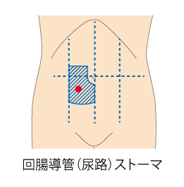 尿路ストーマ