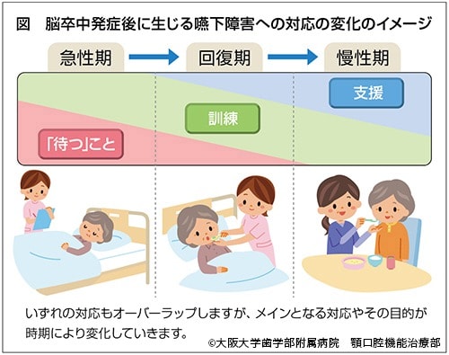 脳卒中発症後に生じる嚥下障害への対応の変化のイメージ解説イラスト