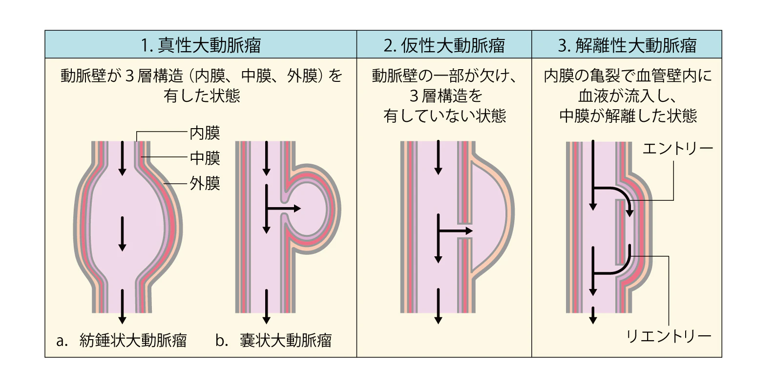 大動脈瘤の分類