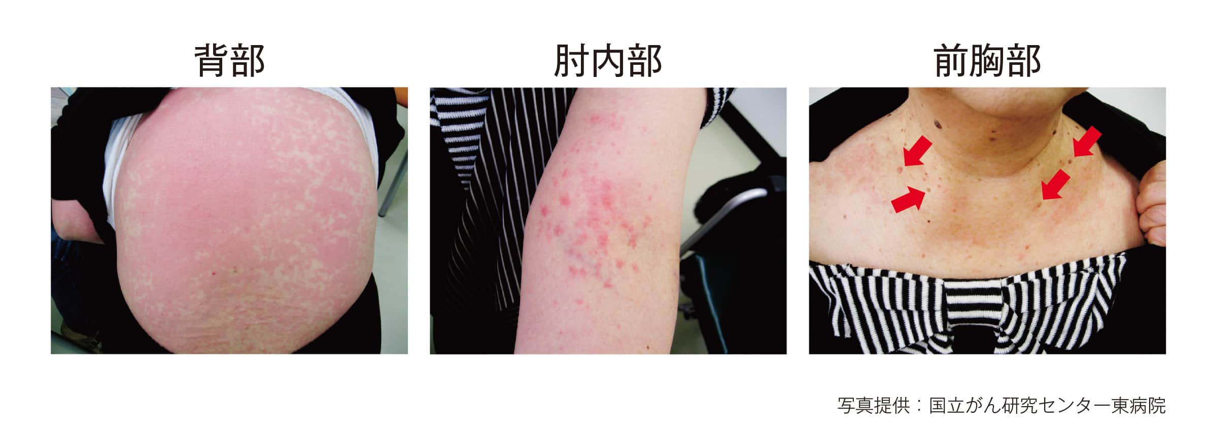 典型的な発疹の例