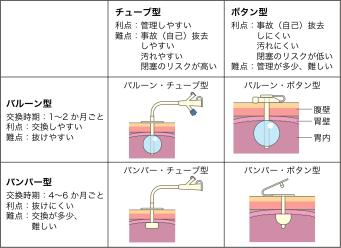 PEGカテーテルの種類別の図