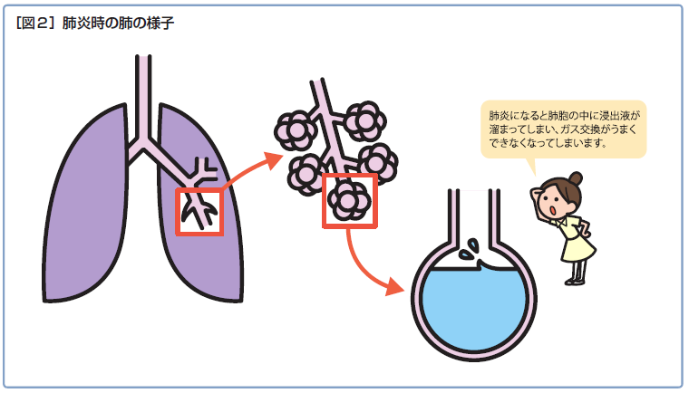 肺炎時の肺の様子