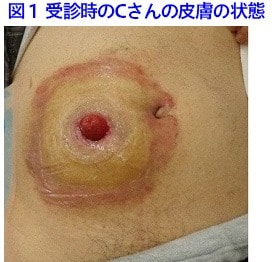 受信時のCさんの皮膚の状態写真