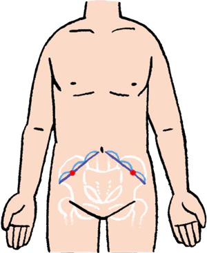 腹水穿刺の穿刺部位