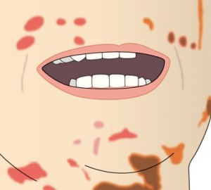生体と同様のやり方で顔そりを行い革皮様化した実際例