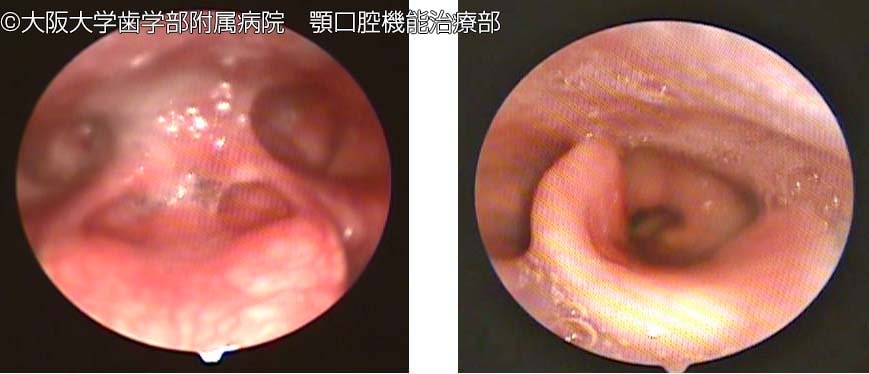 誤嚥説明写真